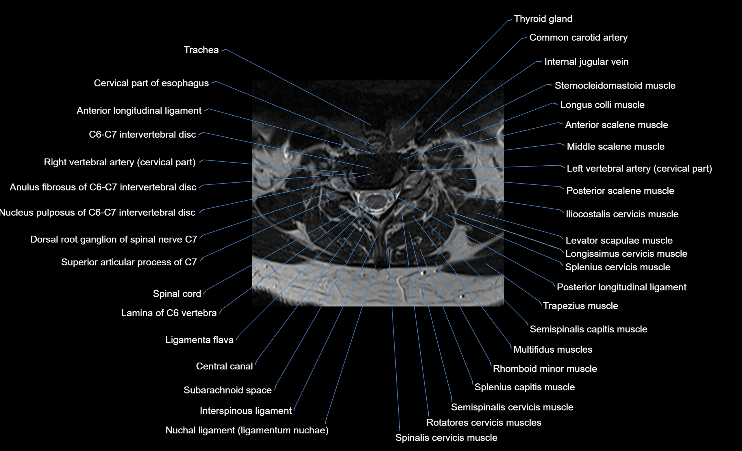 cervical spine cross sectional MRI anatomy  3T MRI axial  image-img-00001-00034.webp